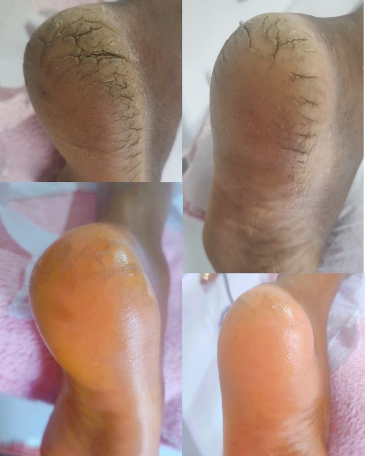 Masque exfoliant pour les pieds